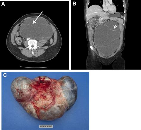 borderline tumor ovar icd